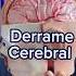 Señales De Que Estás Sufriendo Un Derrame Cerebral Dr William Guerrero Medicina Shorts