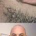 Doctor Reacts To Huge Ingrown Hair Removal Dermreacts Doctorreacts Ingrownhair