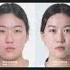 Plasticsurgery Facialcontour Southkorea To Complete The Natural And Pretty V Line