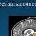 Синдром Арнольда Киари сирингомиелия сколиоз Барселонский Институт Киари