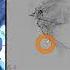 Transradial Prostate Artery Embolization Using N BCA Glue For Benign Prostatic Hyperplasia BPH 2 0