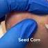 Brace Yourself As We Tackle Seed Corns Head On Your Relief Awaits FootCare PainFreeJourney