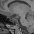 Brain Awareness Video Contest Penfield Epilepsy And The Functional Brain