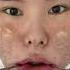 Cirugía De Contorno Facial En La Mejor Clínica En Corea Inquiry Docfinderkorea Org