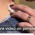 Never Squeeze Acne With Your Hands