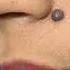 Best Mole Removal Treatment At Skinaa Clinic Viral