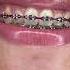 Best Braces Colors For Whiter Looking Teeth Part 1