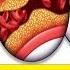 Clean Out Your Arteries Prevent Heart Attack