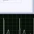ECG Holter Examination Case 1 Ectopic Atrial Rhythm With Phasic Sinus Arrhythmia