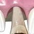 Tooth Implant Procedure STEP BY STEP
