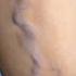 Using A Laser To Zap Varicose Veins 3D Animation