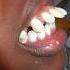 Braces For Buck Teeth Braces Orthodontist Dentist Dental