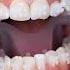 BRACES ON Reels Shullmanorthodontics