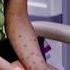 The Skin Crisis No One Could Solve Dr Pimple Popper TLC