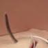 How To Repair An Episiotomy Or 1st 2nd Degree Perineal Tear