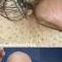 Monsterous Ingrown Hair Ingrownhair Doctorreacts