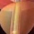Urethral Catheter And Prostatic Stent Introduction