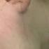 Laser Hair Removal Sideburns
