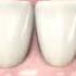 Venus White Teeth Whitening System