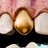 Why Dentists Still Use Gold Teeth