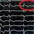 Mitral Annular Disjunction And Arrhythmias