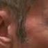 Sideburns Hair Loss Transplant Surgery Result 1 Year After Facial Hair Dr Diep Www Mhtaclinic Com