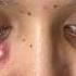 Patches To The Rescue Acne Acnetreatment Cystic Cystpoping Acnepatch Pimplepatch Acnescars