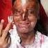 Your Dreams Are Valid Acid Attack Survivor Scores 95 6 In Class 12 CBSE Boards Maktoob