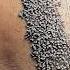 Youth Hair Transplant Focusing On Widow S Peak Reduction Vincihairclinic Shorts