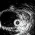 Dr Tuchek EVAR With IVUS Case Study 1