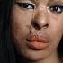 ACID ATTACK My Story Crime Documentary Real Stories