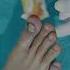 Nail Infection Surgery Partial Nail Avulsion Advanced Treatment At Skinaa Clinic Jaipur Ytshort