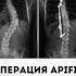 Как вылечить СКОЛИОЗ Операция ApiFix Апификс меднавигатор сколиоз позвоночник