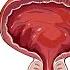 The ONE FOOD That Shrinks An Enlarged Prostate