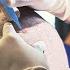 Rafet El Roman Turkish German Pop Singer Had A DHI Hair Transplant In Turkey