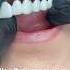 No Other Cosmetic Appliance Does This Snap On Smile