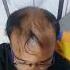 Hair Regrowth 4 Months Result Without Hair Transplant
