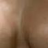 Before After Of Breast Enlargement